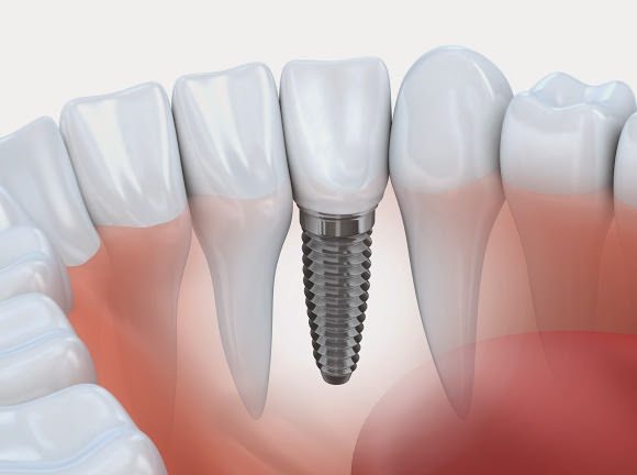 perda de implante dentário