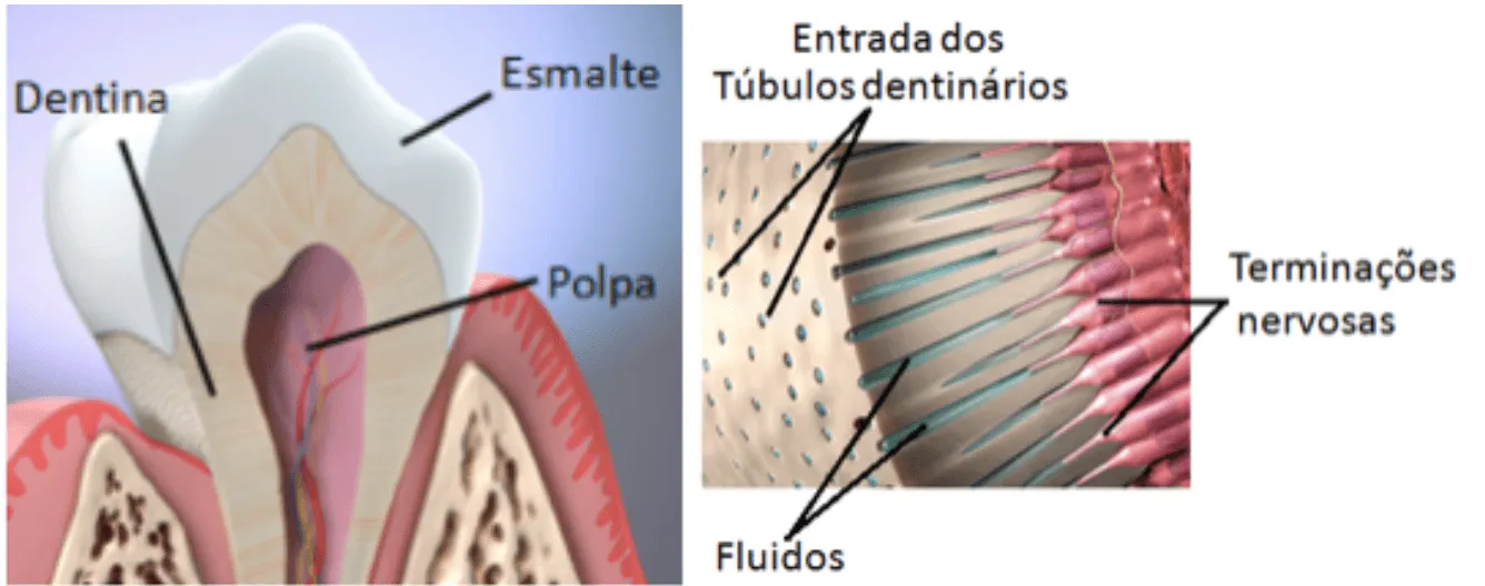 Ilustração da exposição da dentina