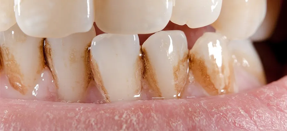 Mancha no Dente: 5 Tipos e os Tratamentos Estéticos